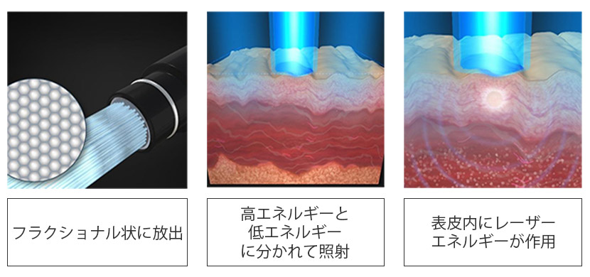 ピコフラクショナルの特徴